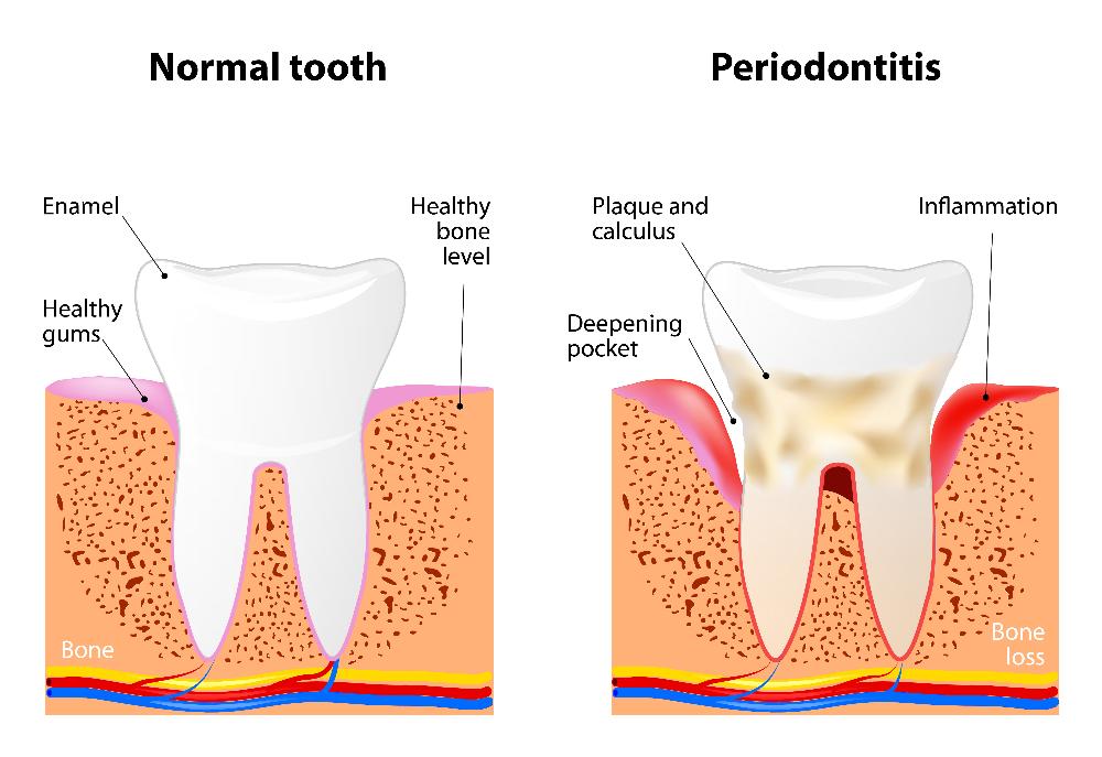 image of periodontal disease | gum disease treatment cookeville tn