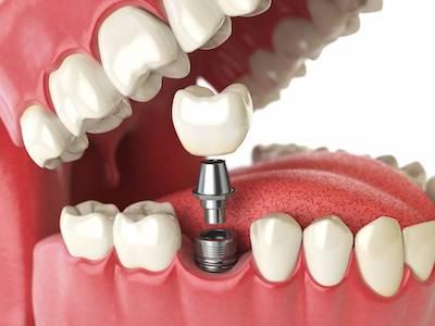 dental implant in jaw | dental implant cookeville tn